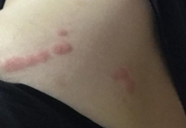 Воронежцев предупредили о тропических постельных клопах