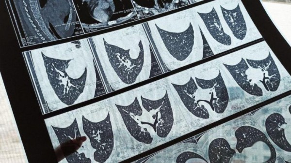 Эксперт Минздрава призвал не делать КТ &laquo;на всякий случай&raquo;